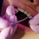 Come scegliere l’apparecchio giusto per i propri denti?